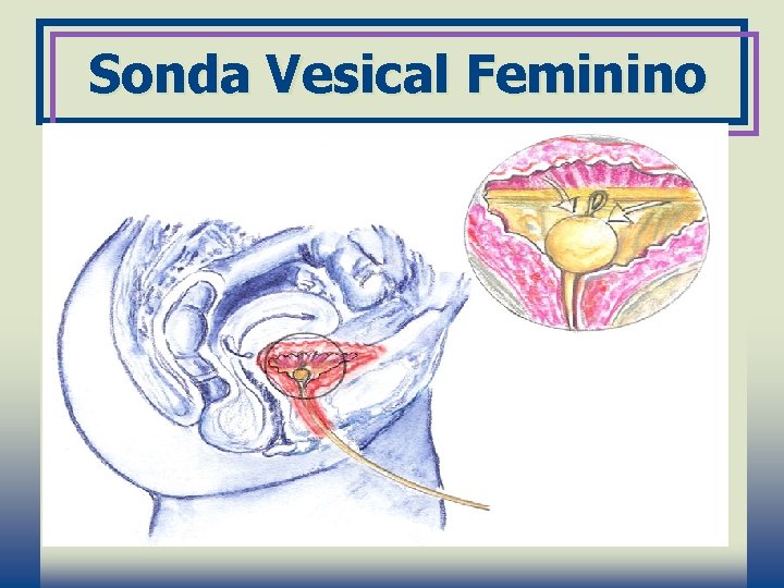 Sonda Vesical Feminino 