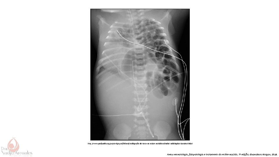 http: //www. pedia. org/pro/artigo-profissional/radiografia-de-torax-no-recem-nascido-achados-radiologicos-caracteristicos Avery neonatologia, fisiopatologia e tratamento do recém-nascido, 7ª edição, Guanabara