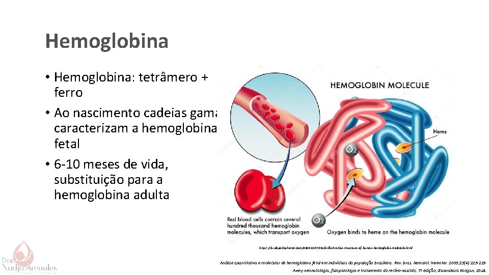 Hemoglobina • Hemoglobina: tetrâmero + ferro • Ao nascimento cadeias gama caracterizam a hemoglobina