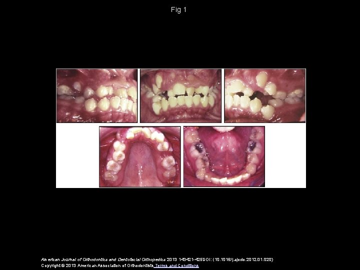 Fig 1 American Journal of Orthodontics and Dentofacial Orthopedics 2013 143421 -425 DOI: (10.