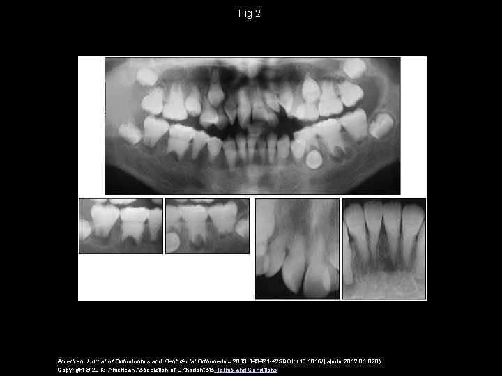 Fig 2 American Journal of Orthodontics and Dentofacial Orthopedics 2013 143421 -425 DOI: (10.