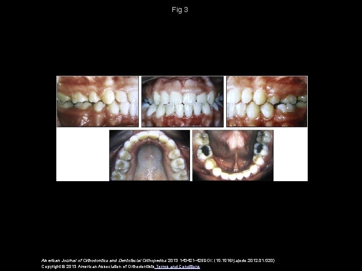 Fig 3 American Journal of Orthodontics and Dentofacial Orthopedics 2013 143421 -425 DOI: (10.