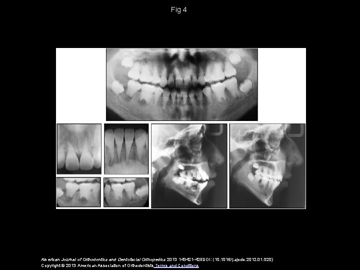 Fig 4 American Journal of Orthodontics and Dentofacial Orthopedics 2013 143421 -425 DOI: (10.