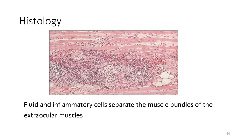 Histology Fluid and inflammatory cells separate the muscle bundles of the extraocular muscles 10