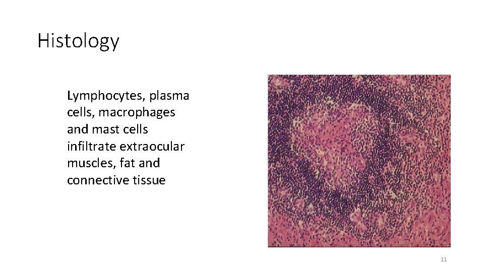 Histology Lymphocytes, plasma cells, macrophages and mast cells infiltrate extraocular muscles, fat and connective