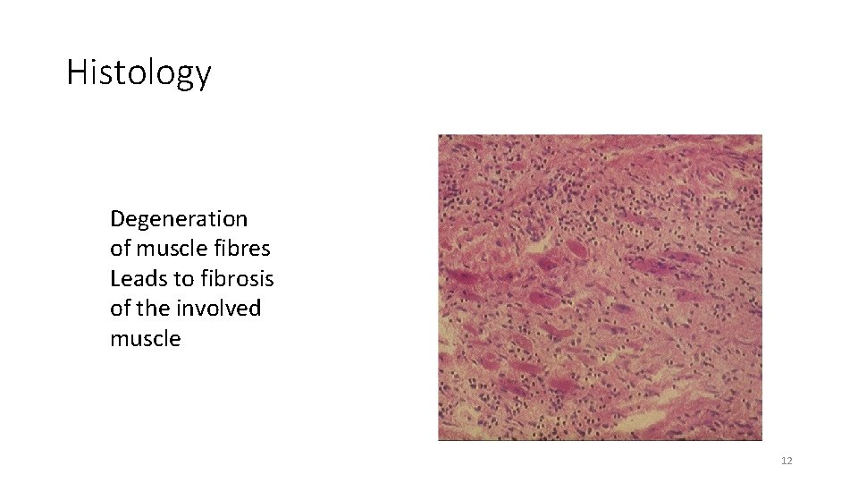 Histology Degeneration of muscle fibres Leads to fibrosis of the involved muscle 12 