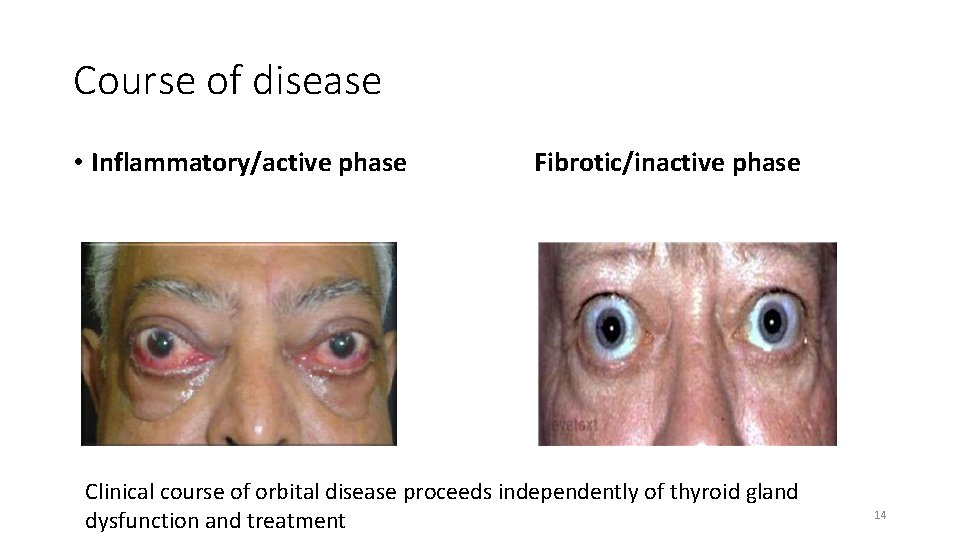 Course of disease • Inflammatory/active phase Fibrotic/inactive phase Clinical course of orbital disease proceeds