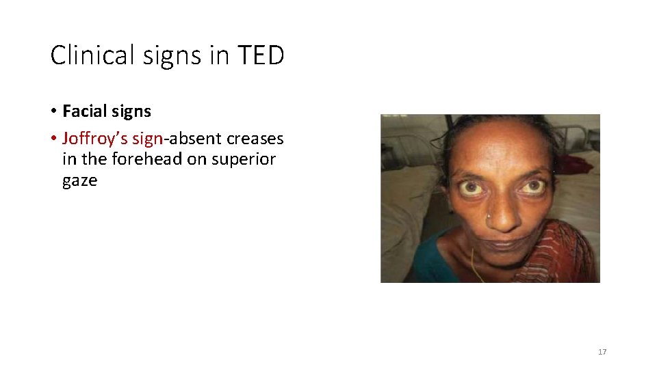 Clinical signs in TED • Facial signs • Joffroy’s sign-absent creases in the forehead