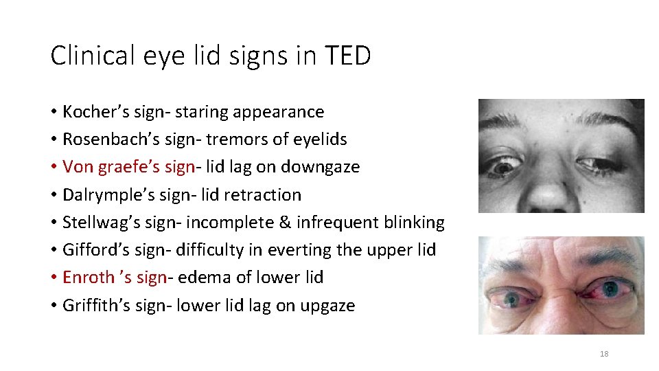 Clinical eye lid signs in TED • Kocher’s sign- staring appearance • Rosenbach’s sign-