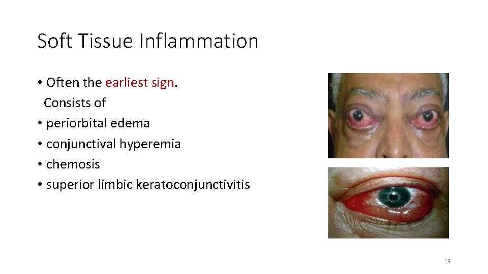 Soft Tissue Inflammation • Often the earliest sign. Consists of • periorbital edema •