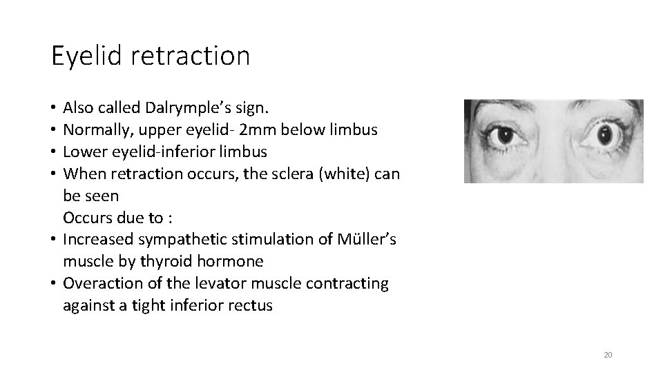 Eyelid retraction • Also called Dalrymple’s sign. • Normally, upper eyelid- 2 mm below