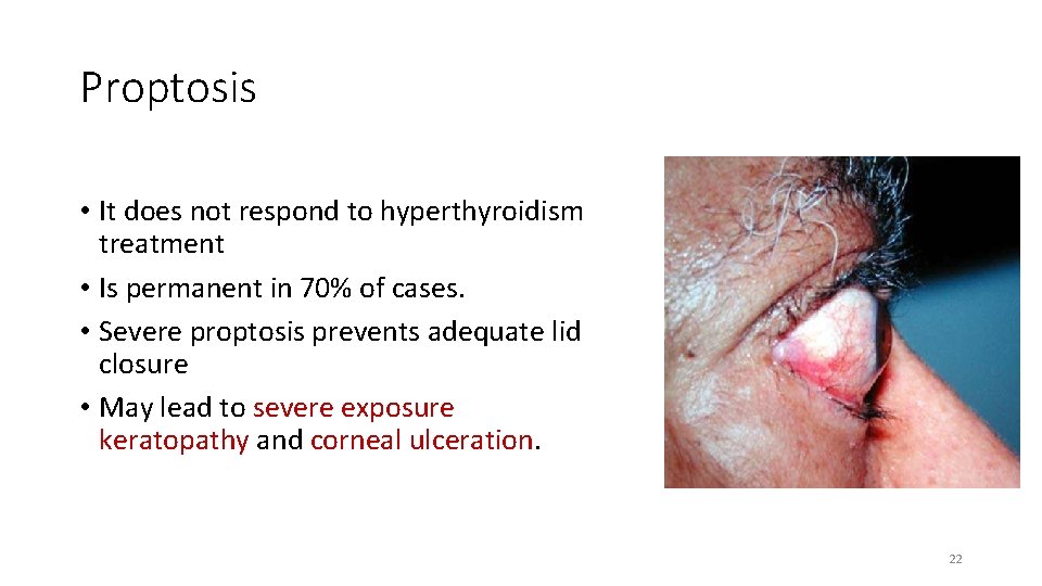 Proptosis • It does not respond to hyperthyroidism treatment • Is permanent in 70%