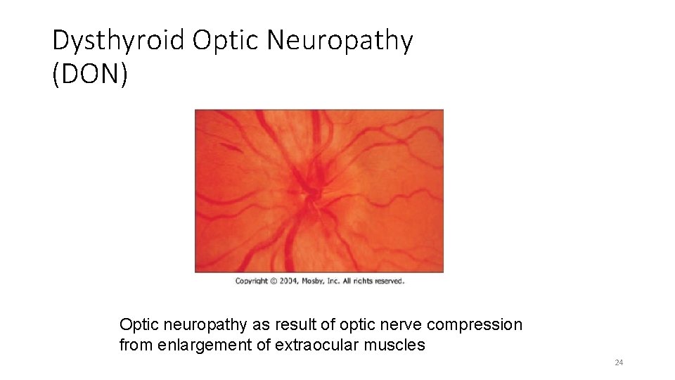 Dysthyroid Optic Neuropathy (DON) Optic neuropathy as result of optic nerve compression from enlargement