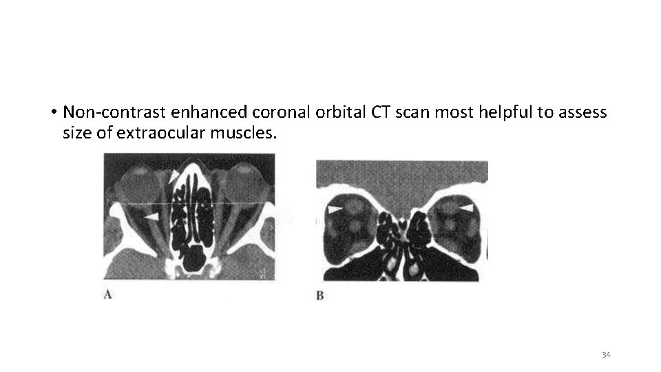  • Non-contrast enhanced coronal orbital CT scan most helpful to assess size of