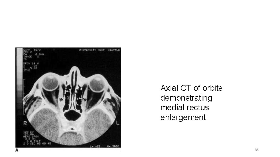 Axial CT of orbits demonstrating medial rectus enlargement 35 