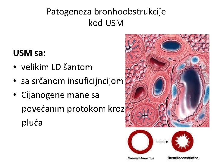 Patogeneza bronhoobstrukcije kod USM sa: • velikim LD šantom • sa srčanom insuficijncijom •