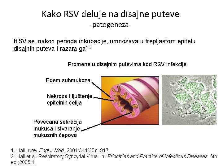 Kako RSV deluje na disajne puteve -patogeneza- RSV se, nakon perioda inkubacije, umnožava u