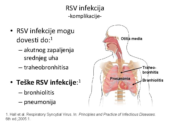 RSV infekcija -komplikacije- • RSV infekcije mogu dovesti do: 1 Otitis media – akutnog