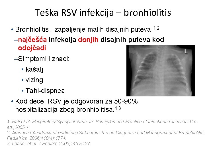 Teška RSV infekcija – bronhiolitis • Bronhiolitis - zapaljenje malih disajnih puteva: 1, 2