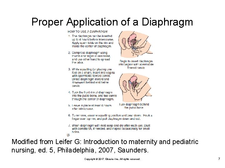 Proper Application of a Diaphragm Modified from Leifer G: Introduction to maternity and pediatric