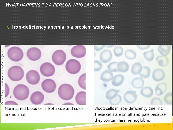 WHAT HAPPENS TO A PERSON WHO LACKS IRON? Iron-deficiency anemia is a problem worldwide