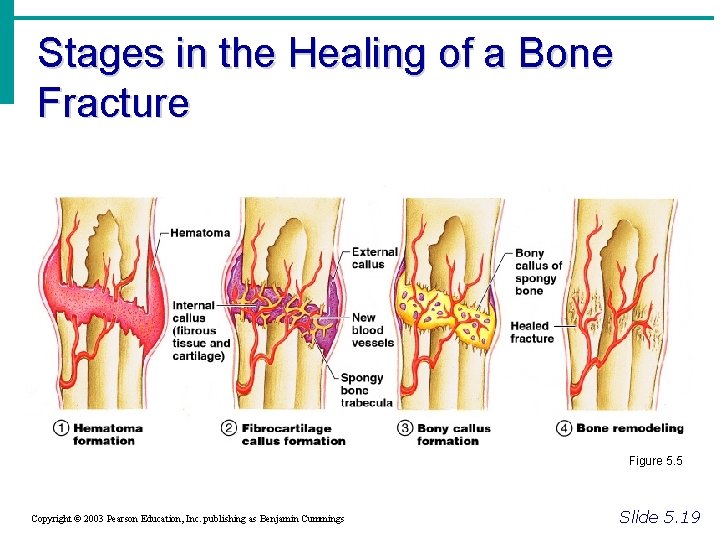 Stages in the Healing of a Bone Fracture Figure 5. 5 Copyright © 2003