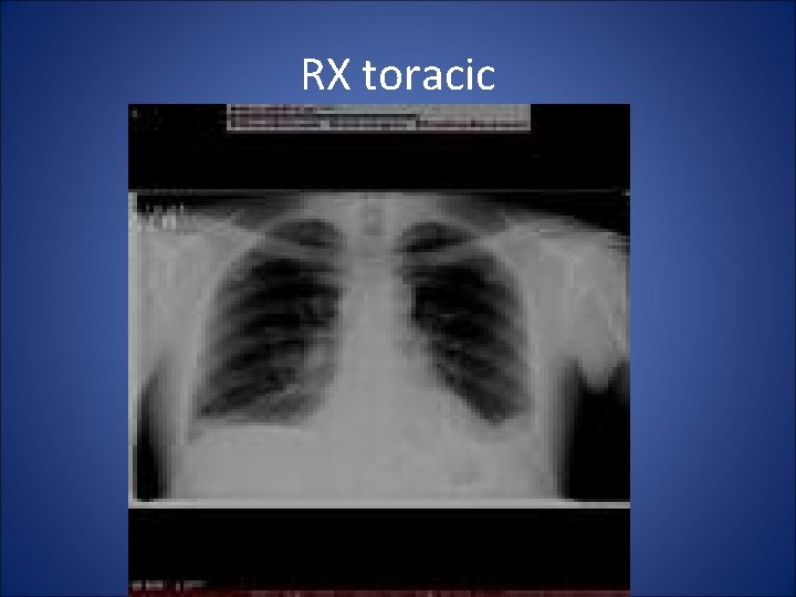 RX toracic 