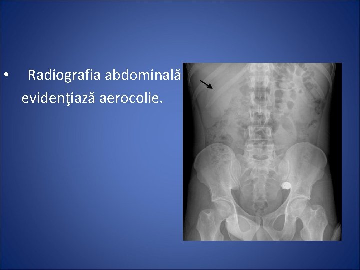  • Radiografia abdominală evidenţiază aerocolie. 