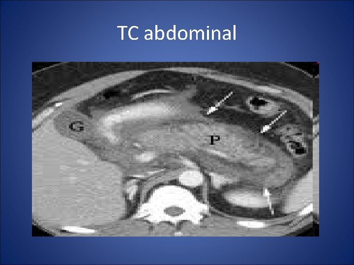 TC abdominal 