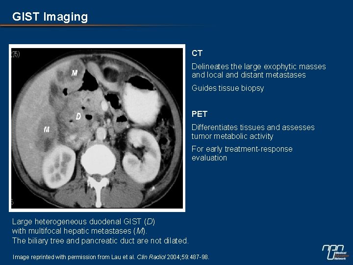 GIST Imaging CT • Delineates the large exophytic masses and local and distant metastases