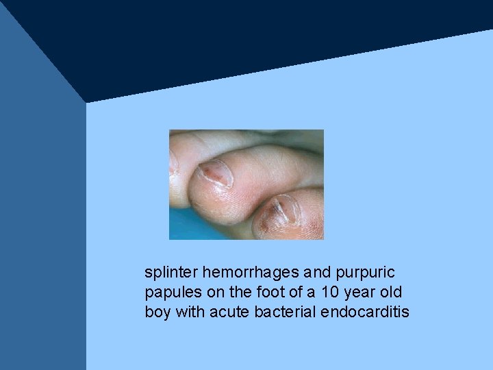 splinter hemorrhages and purpuric papules on the foot of a 10 year old boy