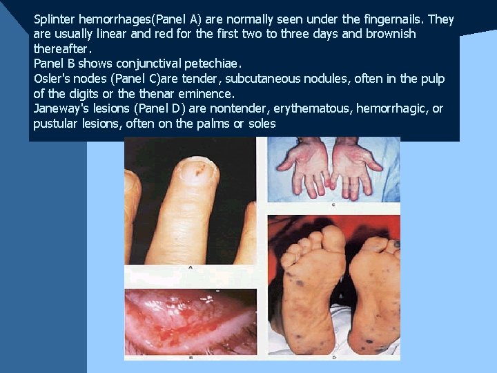 Splinter hemorrhages(Panel A) are normally seen under the fingernails. They are usually linear and