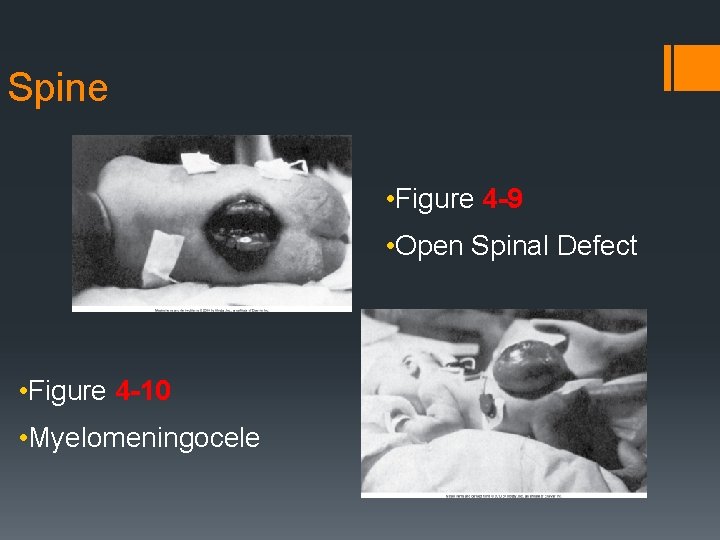 Spine • Figure 4 -9 • Open Spinal Defect • Figure 4 -10 •