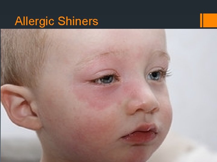 Allergic Shiners 