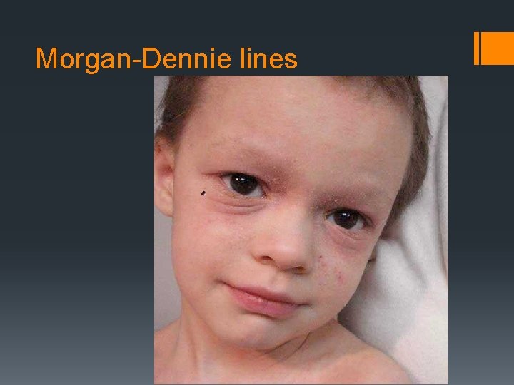 Morgan-Dennie lines 