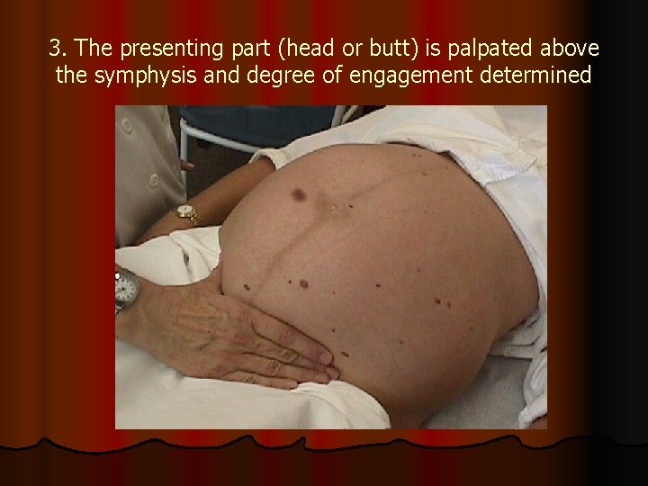 3. The presenting part (head or butt) is palpated above the symphysis and degree