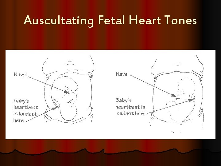 Auscultating Fetal Heart Tones 