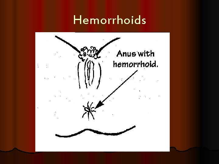 Hemorrhoids 