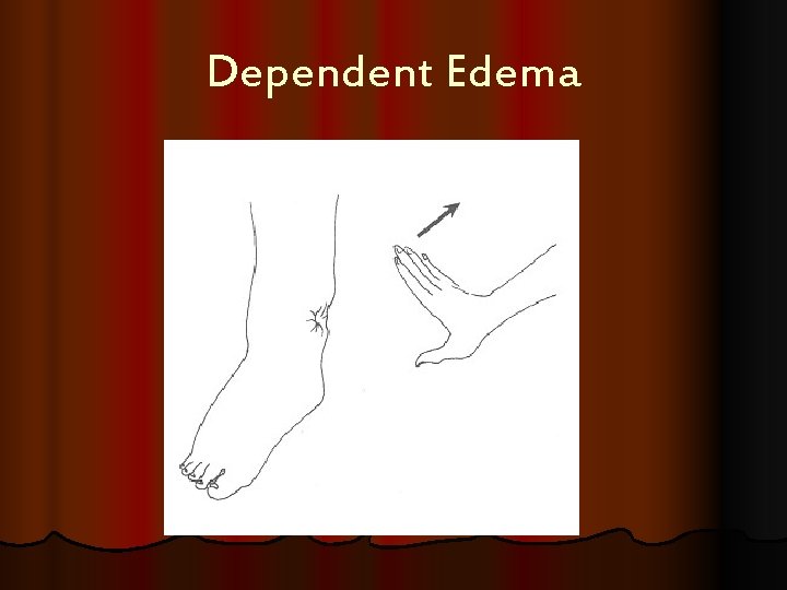 Dependent Edema 