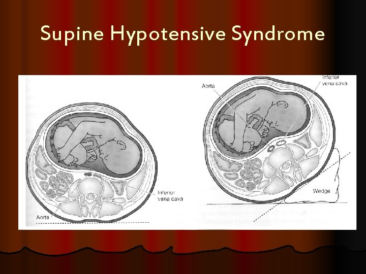 Supine Hypotensive Syndrome 