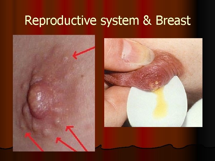 Reproductive system & Breast 