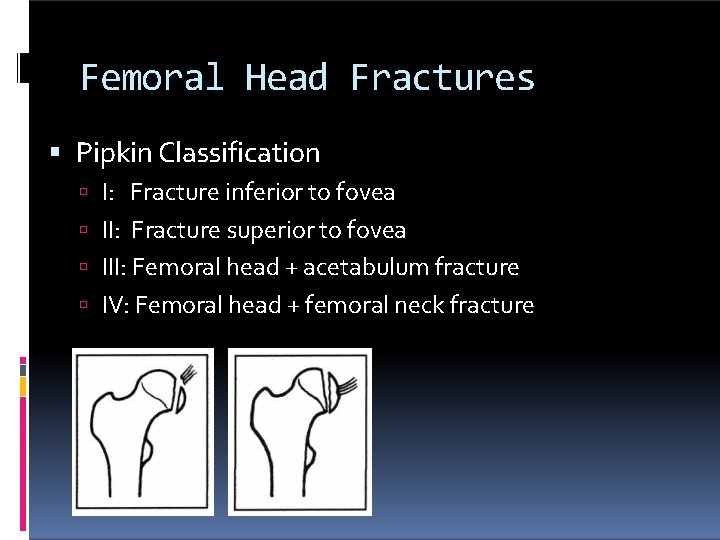 Femoral Head Fractures Pipkin Classification I: Fracture inferior to fovea II: Fracture superior to