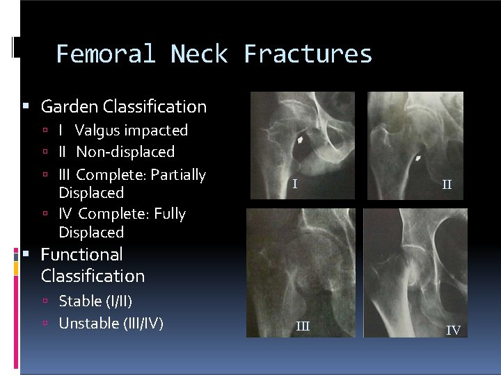 Femoral Neck Fractures Garden Classification I Valgus impacted II Non-displaced III Complete: Partially Displaced