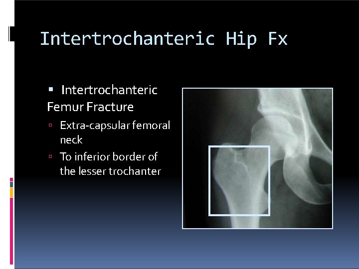 Intertrochanteric Hip Fx Intertrochanteric Femur Fracture Extra-capsular femoral neck To inferior border of the