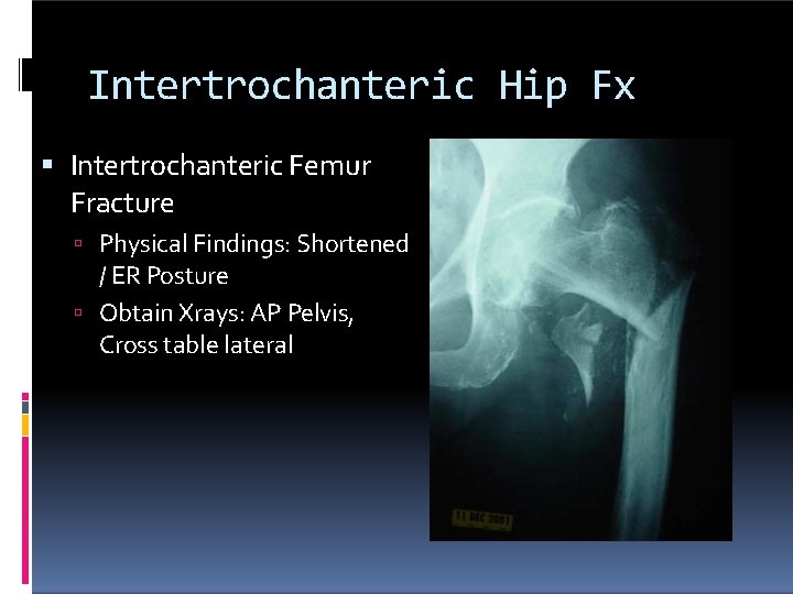 Intertrochanteric Hip Fx Intertrochanteric Femur Fracture Physical Findings: Shortened / ER Posture Obtain Xrays: