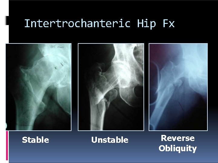 Intertrochanteric Hip Fx Stable Unstable Reverse Obliquity 