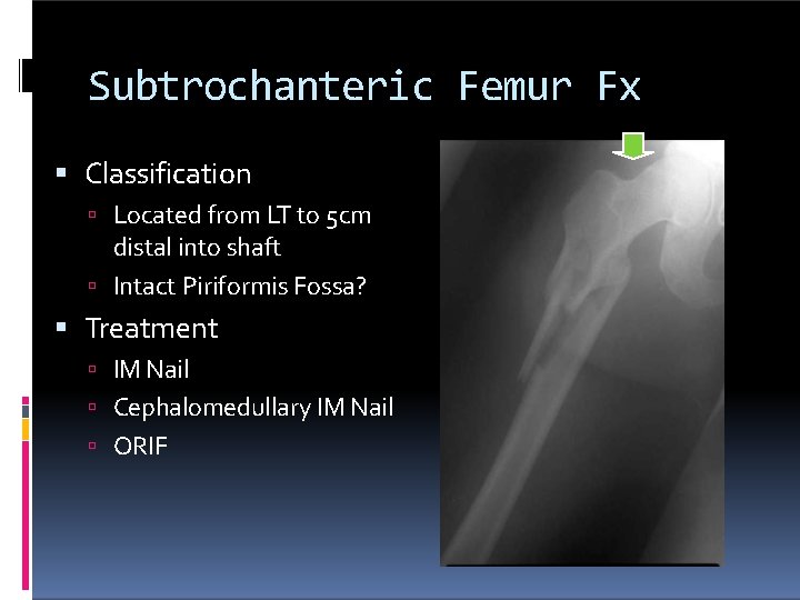 Subtrochanteric Femur Fx Classification Located from LT to 5 cm distal into shaft Intact