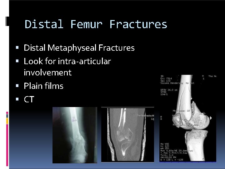 Distal Femur Fractures Distal Metaphyseal Fractures Look for intra-articular involvement Plain films CT 