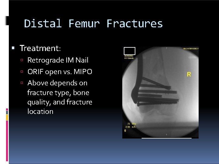 Distal Femur Fractures Treatment: Retrograde IM Nail ORIF open vs. MIPO Above depends on