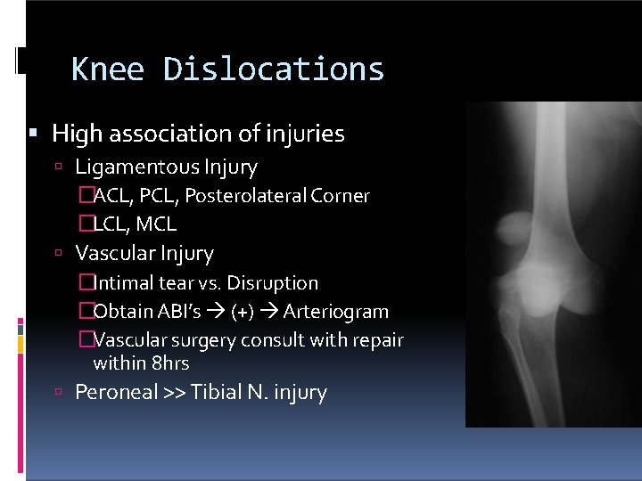 Knee Dislocations High association of injuries Ligamentous Injury �ACL, Posterolateral Corner �LCL, MCL Vascular